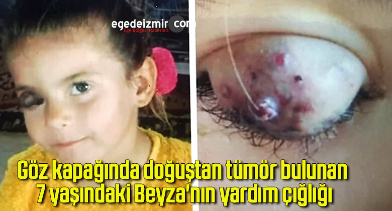 Göz kapağında doğuştan tümör bulunan 7 yaşındaki Beyza’nın yardım çığlığı