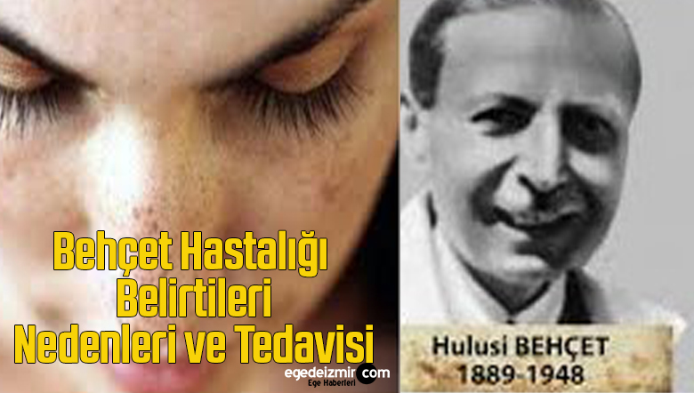 behcet