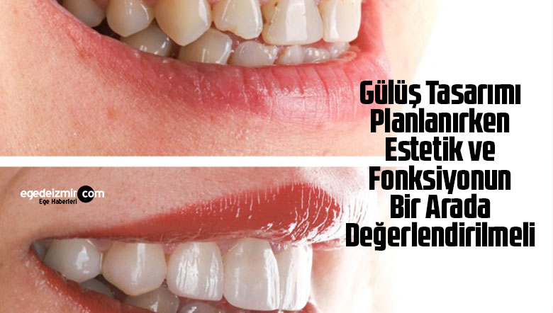gülüş tasarımı